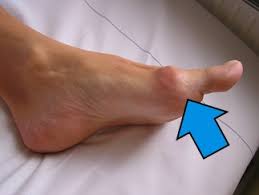 Leczenie palucha sztywnego