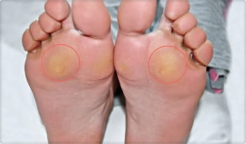 Płaskostopie poprzeczne